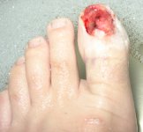 toe.jpg